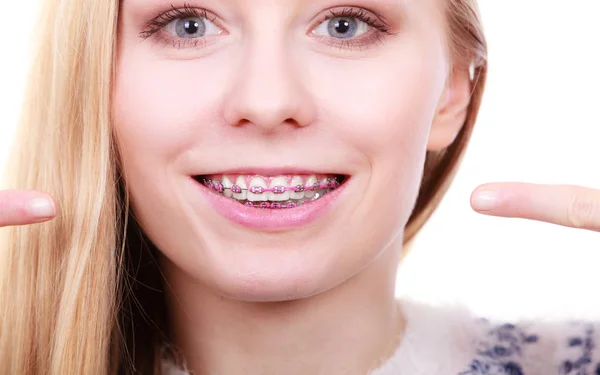 Mulher feliz mostrando seus aparelhos nos dentes — Fotografia de Stock