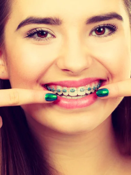 Mujer mostrando sus dientes con aparatos ortopédicos — Foto de Stock