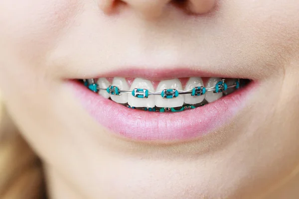 Kadın dişlerinin diş telleriyle yakınlaştırılması — Stok fotoğraf