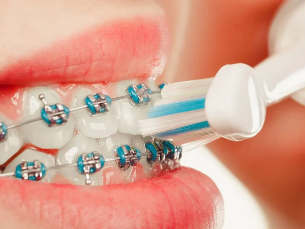 Woman smiling cleaning teeth with braces — Stock Photo, Image