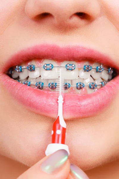 Woman brushing teeth with braces using brush — Stock Photo, Image