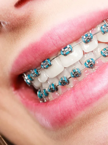 Woman showing her teeth with braces Royalty Free Stock Images