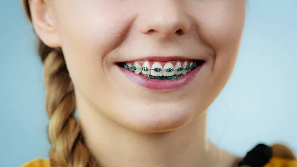 Крупный план женских зубов с брекетами — стоковое фото