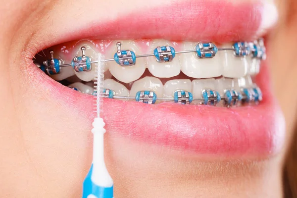 Mujer cepillándose los dientes con aparatos ortopédicos usando cepillo —  Fotos de Stock
