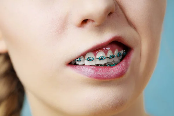 Primo piano di denti donna con bretelle, faccia divertente — Foto Stock
