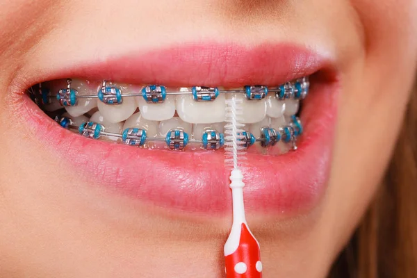 Mulher sorrindo dentes de limpeza com aparelho — Fotografia de Stock