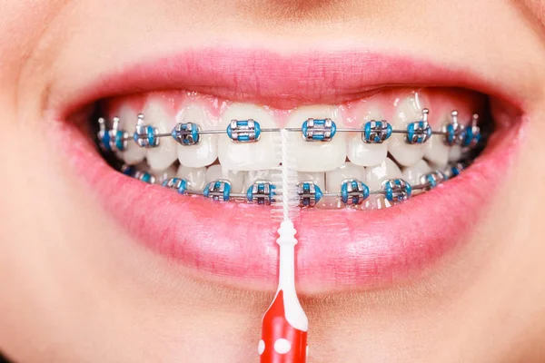 Woman brushing teeth with braces using brush — Stock Photo, Image