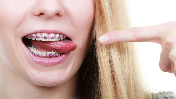 Happy woman showing her braces on teeth — Stock Photo, Image