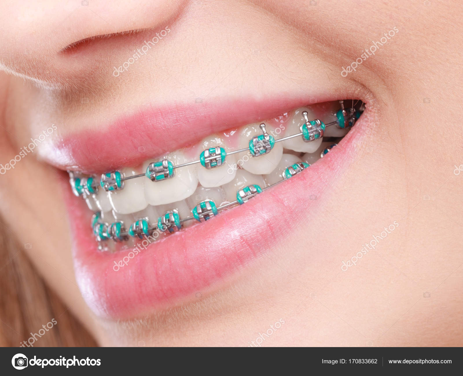 Съемные брекеты на вб артикул для красоты. Брекет система. Керамические брекеты. Съемные брекеты на вб артикул для красоты. Съемные брекеты на вб артикул для красоты.