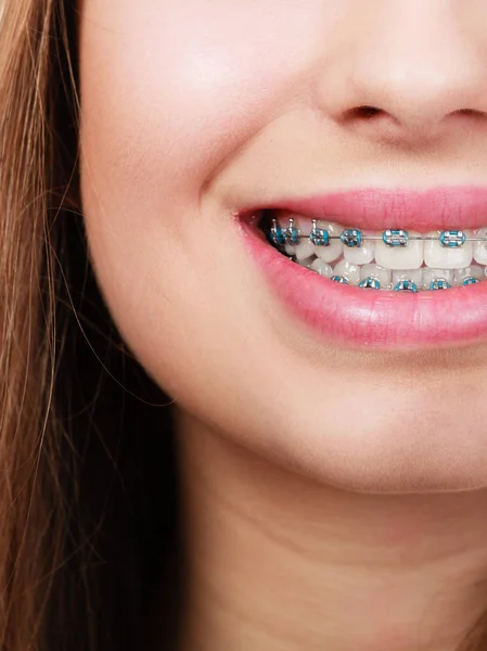 Mujer mostrando sus dientes con aparatos ortopédicos — Foto de Stock