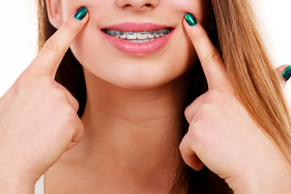 Žena ukazuje její zuby s kšandami — Stock fotografie
