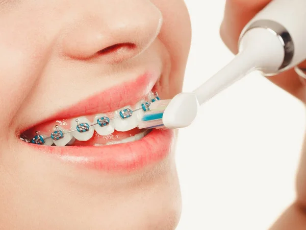 Woman smiling cleaning teeth with braces — Stock Photo, Image