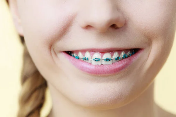 Primo piano di denti donna con bretelle — Foto Stock