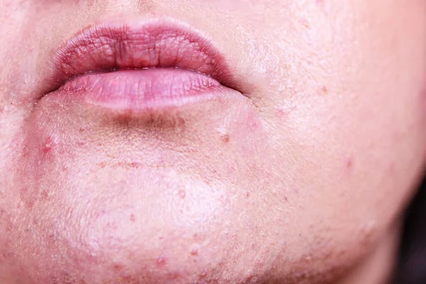 Rosto feminino com problema de pele acne — Fotografia de Stock