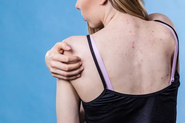 Mulher com acne problema de pele nas costas — Fotografia de Stock