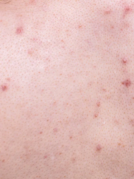 Closeup human skin with problem