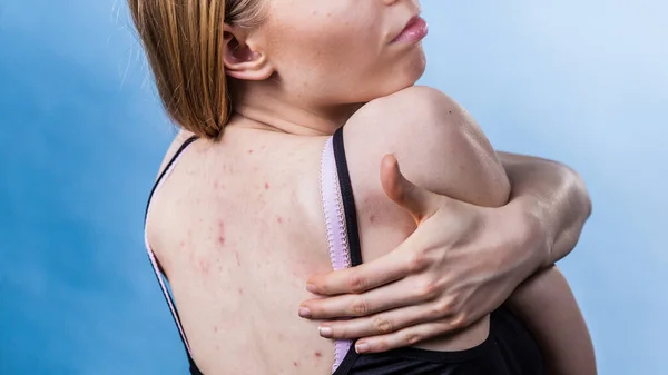 Woman with skin problem acne on back — Stock Photo, Image