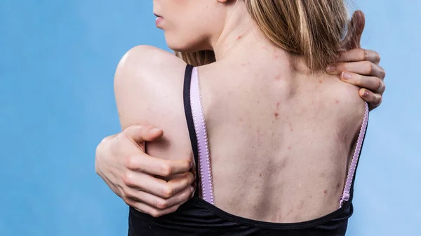 Жінка з проблемою шкіри прищі на спині — стокове фото