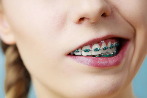 Detailní záběr zubů žena s kšandami, legrační obličej — Stock fotografie