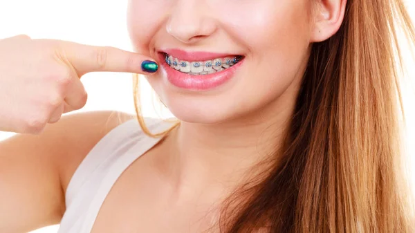 Mujer mostrando sus dientes con aparatos ortopédicos —  Fotos de Stock