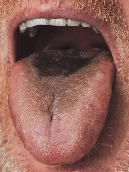 Чорний волохатий язик крупним планом — стокове фото