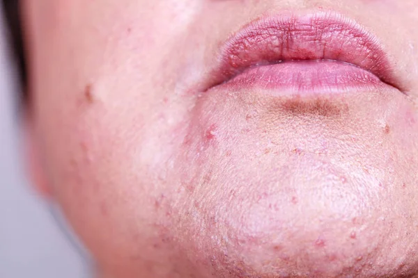 Female face with acne skin problem