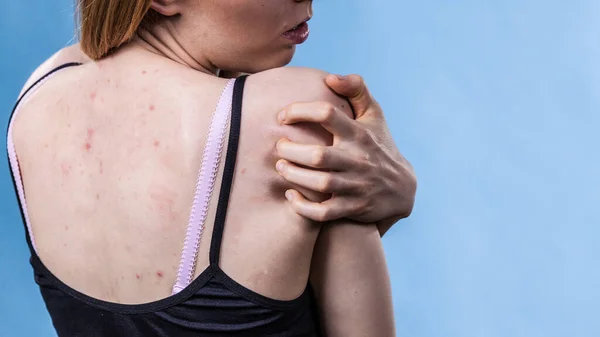 Gezondheidsproblemen Huidziekten Jonge Vrouw Die Haar Rug Laat Zien Met — Stockfoto