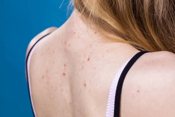 Zdravotní Problém Kožní Onemocnění Mladá Žena Ukazuje Záda Alergickou Vyrážkou — Stock fotografie