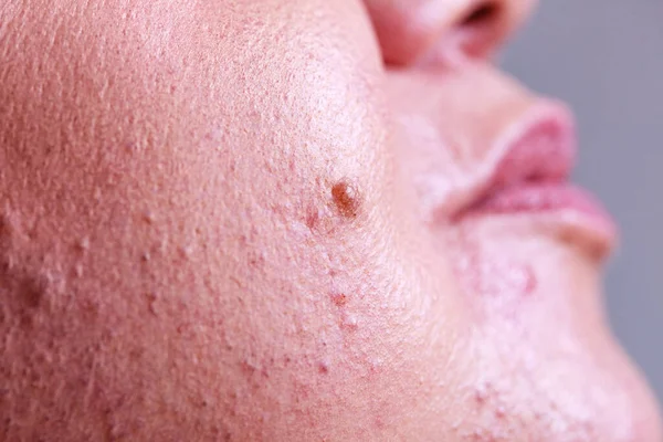 Δέρμα Λέιζερ Αφαίρεση Ανεπιθύμητης Τρίχας Από Πρόσωπο Λεπτομέρεια Διαδικασία Επιληψίας — Φωτογραφία Αρχείου