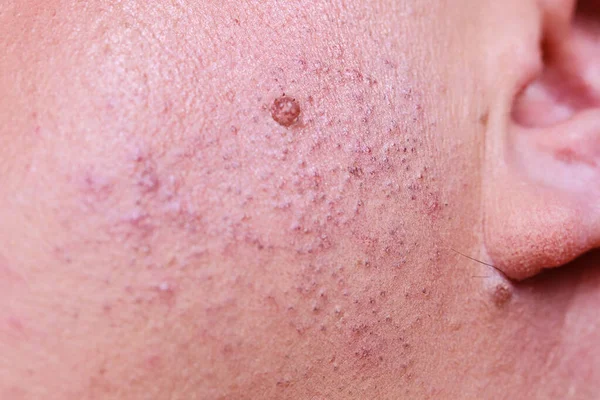 Δέρμα Λέιζερ Αφαίρεση Ανεπιθύμητης Τρίχας Από Πρόσωπο Λεπτομέρεια Διαδικασία Επιληψίας — Φωτογραφία Αρχείου