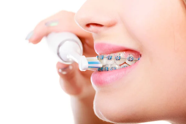 Концепція Стоматолога Ортодонта Молода Жінка Чистить Чистить Зуби Синіми Брекетами — стокове фото