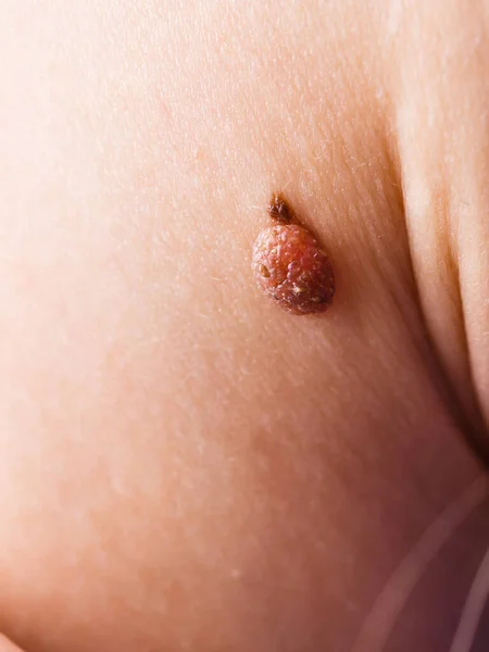 Skin Disease Closeup Brown Mole Caucasian Human Body — Stock Photo, Image