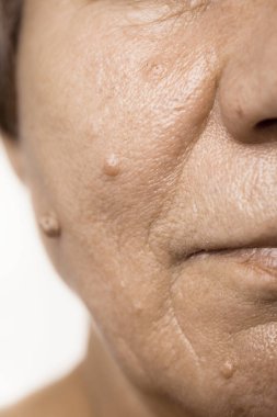 Details of senior woman face. Elderly pensioner female, dermal fibroma close up. clipart