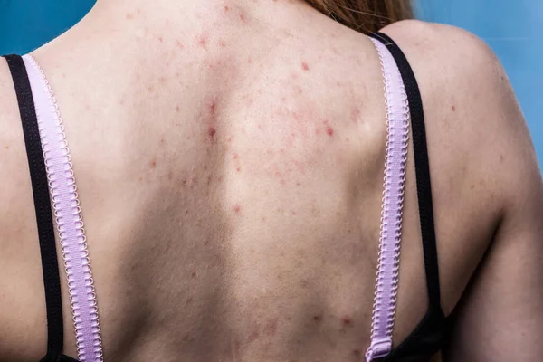 Health Problem Skin Diseases Young Woman Showing Her Back Allergy — Stock Photo, Image