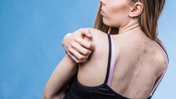 Gezondheidsproblemen Huidziekten Jonge Vrouw Die Haar Rug Laat Zien Met — Stockfoto