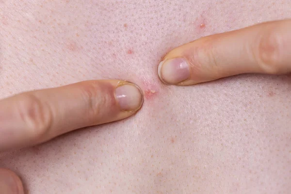 Mulher Com Espinhas Manchas Vermelhas Dermatoses Problemas Pele Problema Dermatológico — Fotografia de Stock