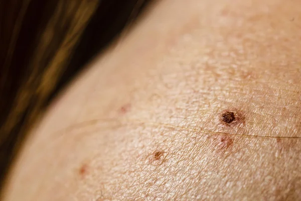 有粉刺 痣和红斑的近处皮肤 健康问题 皮肤病 — 图库照片