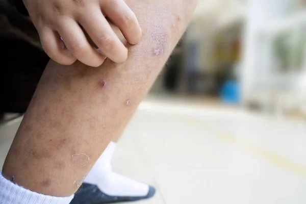 Klein Aziatisch jongen heeft allergieën met muggen bijten en jeuk — Stockfoto