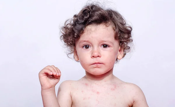 Roseola Stock Photos Royalty Free Roseola Images Depositphotos