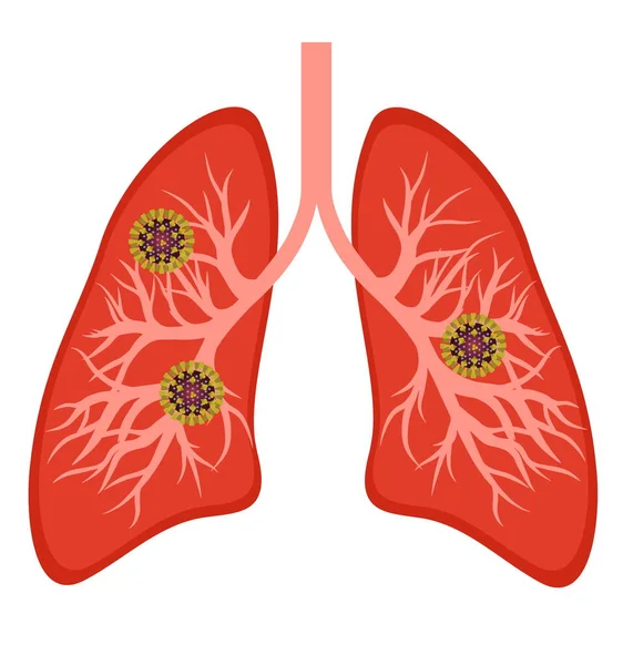 白背景下人类肺概念设计中的结肠病毒或Covid 19炎症原因 — 图库照片