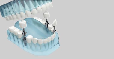 Diş implantlarının bileşeni. Mavi renk şeffaf. 3d illüstrasyon