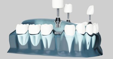 Diş implantlarının bileşeni. Mavi renk şeffaf. 3d illüstrasyon
