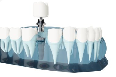 Diş implantlarının bileşenini kapat. Mavi renk şeffaf. 3d illüstrasyon
