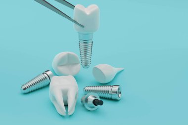 3D rendering Dental implantation concept. Human teeth or dentures tools. clipart