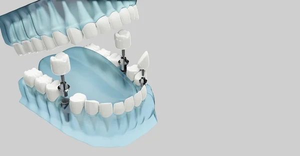 歯科インプラントの構成要素。青い色は透明です。3Dイラスト — ストック写真
