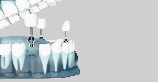 치아 삽 입물 과 복사 공간의 구성 요소. 파란색 투명하게. 3D 삽화 — 스톡 사진