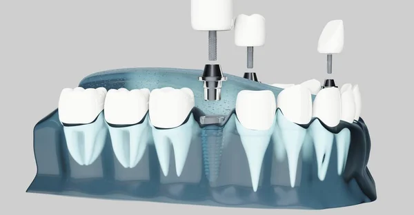 Компонент зубних імплантатів. Синій колір прозорий. 3d ілюстрації — стокове фото