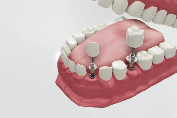 Процедура імплантації зубів. Медично точна концепція 3D ілюстрації зубних протезів . — стокове фото