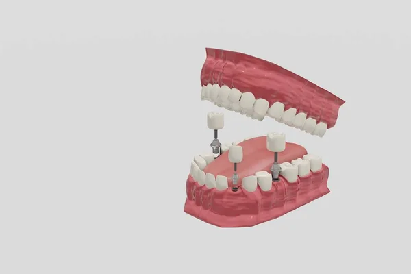 歯科インプラント治療手順。医学的に正確な3Dイラスト入れ歯の概念. — ストック写真