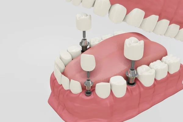 Procedura di trattamento degli impianti dentali. Concetto di protesi 3D per illustrazioni clinicamente accurate . — Foto Stock